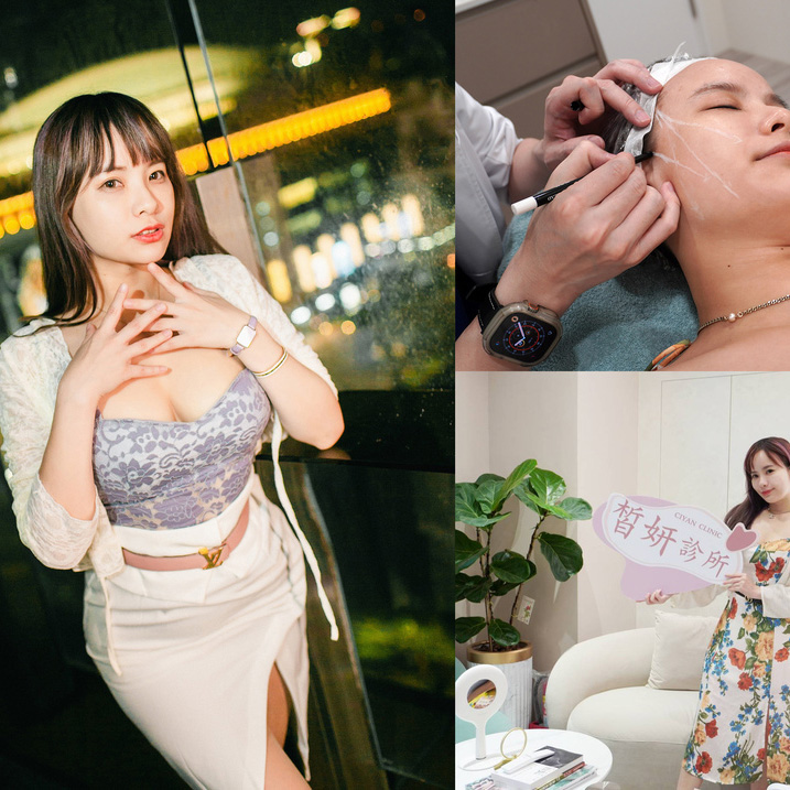 醫美診所推薦｜中山區醫美診所推薦→皙妍診所*V塑拉提(蛇牙線)-改善圓型臉、方型臉，術後立即校正回歸！@愛菲兒的完美世界｜皙妍診所