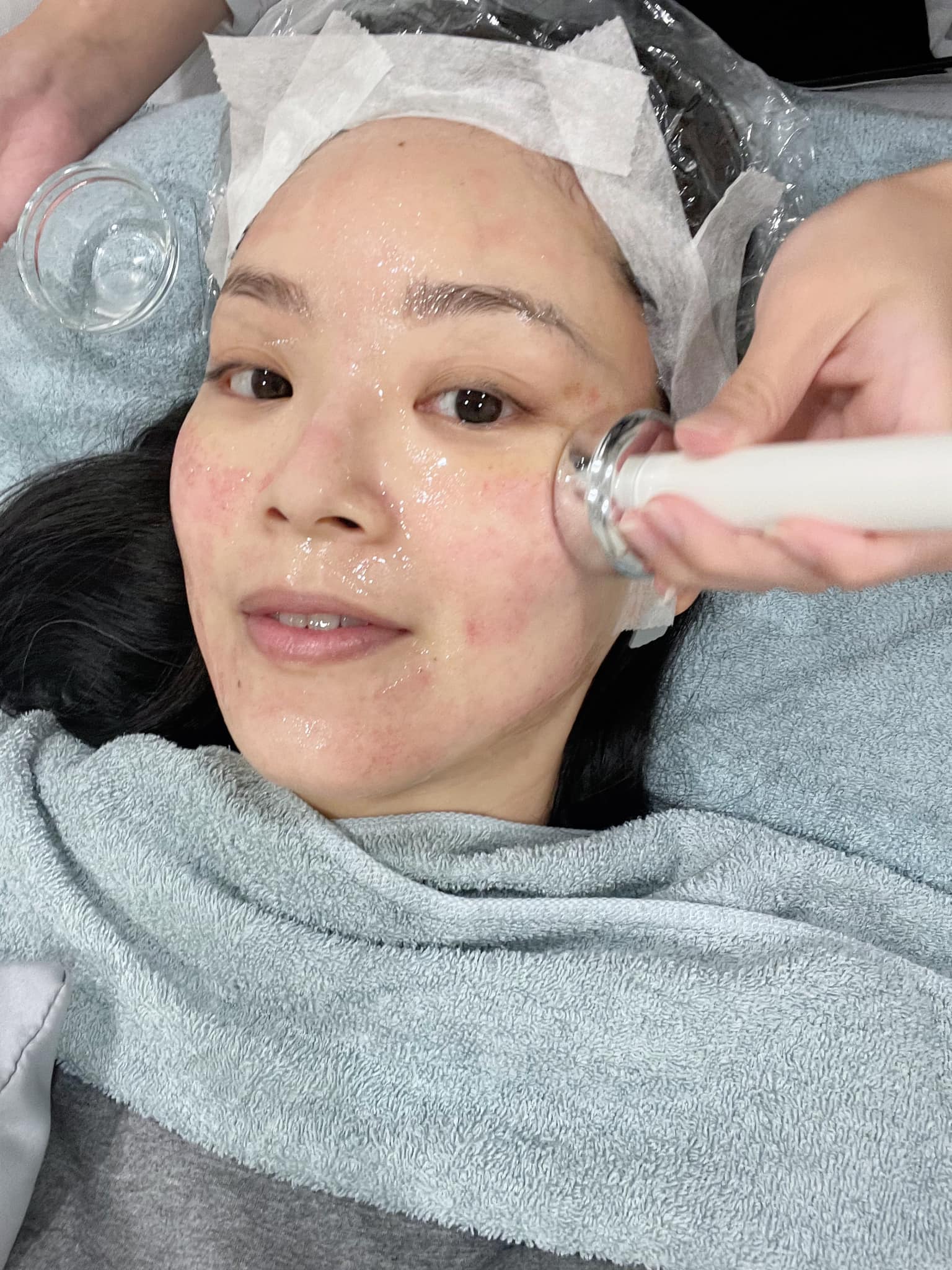 醫美診所推薦｜暗沈什麼的全都沒了!!!臉超級透亮!@葳葳 曾仲葳｜皙妍診所