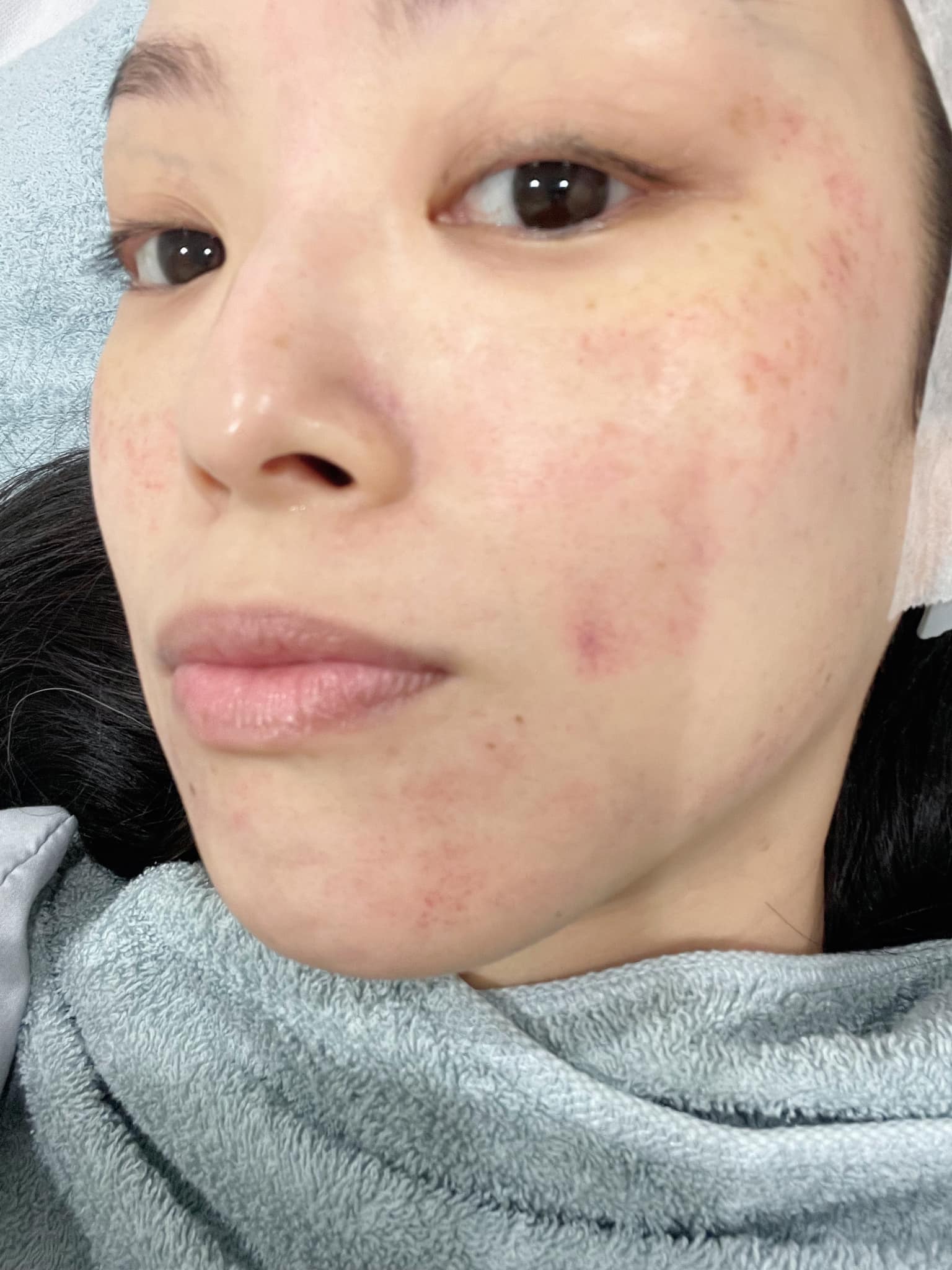 醫美診所推薦｜暗沈什麼的全都沒了!!!臉超級透亮!@葳葳 曾仲葳｜皙妍診所